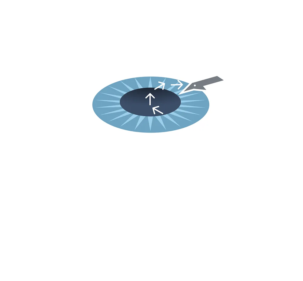 vzx-mc-s05-glaucoma